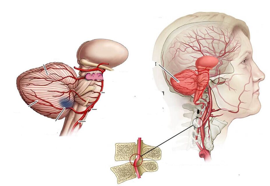 Cerebellar blóðþurrð